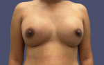 Breast Augmentation 29 After
